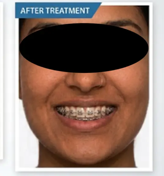 Braces case 1 after treatment
