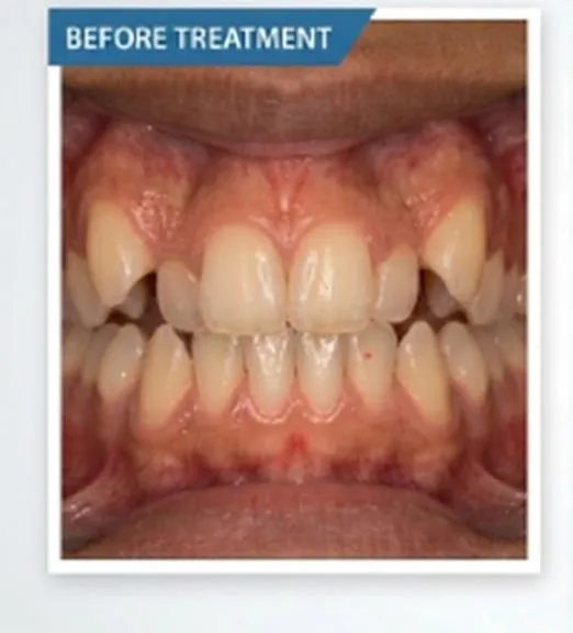 Braces case 1 before treatment